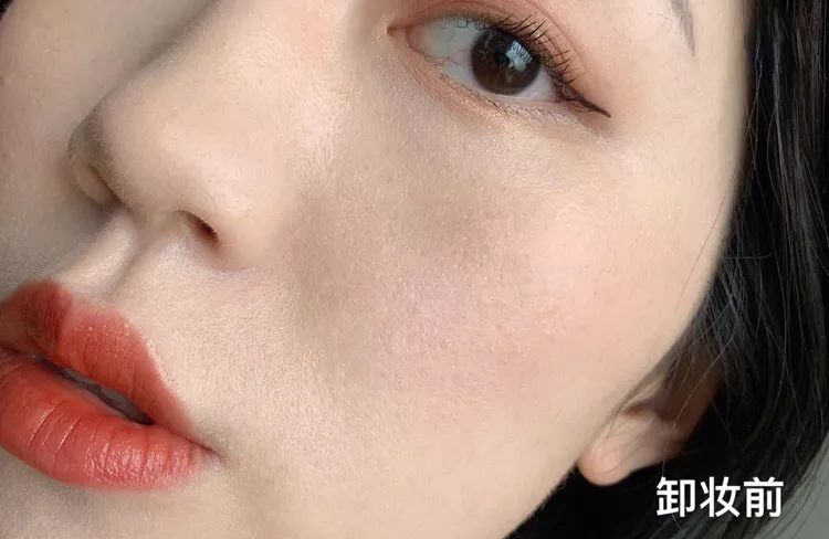 鼻头痘痘挤出来的白色物质是什么,团状红痘痘