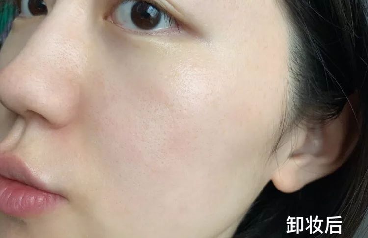 鼻头痘痘挤出来的白色物质是什么,团状红痘痘