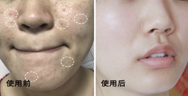 鼻头痘痘挤出来的白色物质是什么,团状红痘痘