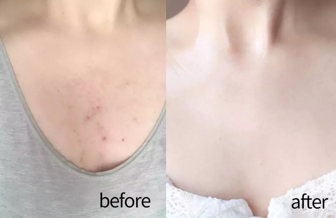 鼻头痘痘挤出来的白色物质是什么,团状红痘痘