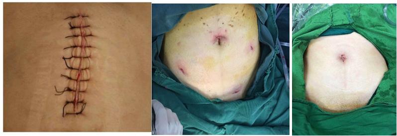 女性单孔腹腔镜术后恢复,腹腔镜术后怎么不留疤