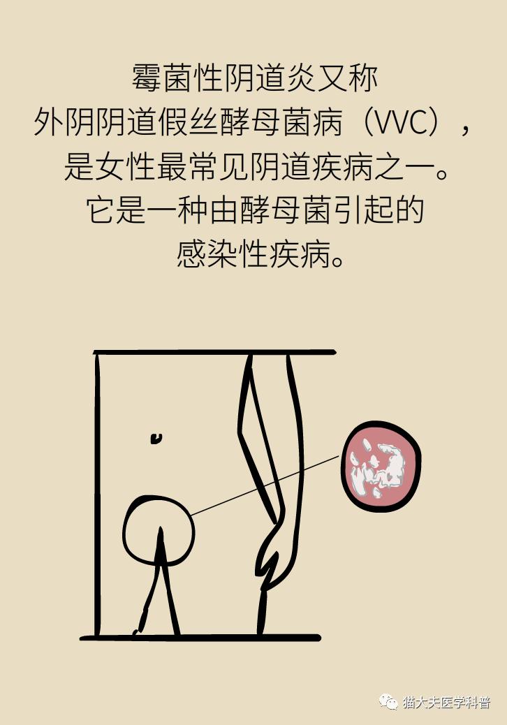 霉菌性阴道炎真的是里面“发霉”了吗？药师教你“抗霉”*法大**