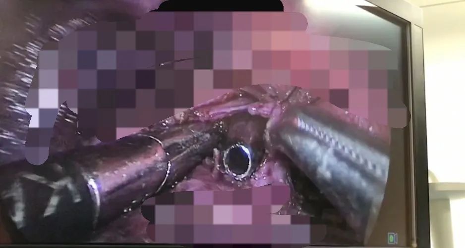 气道异物患者麻醉,小儿气道异物麻醉