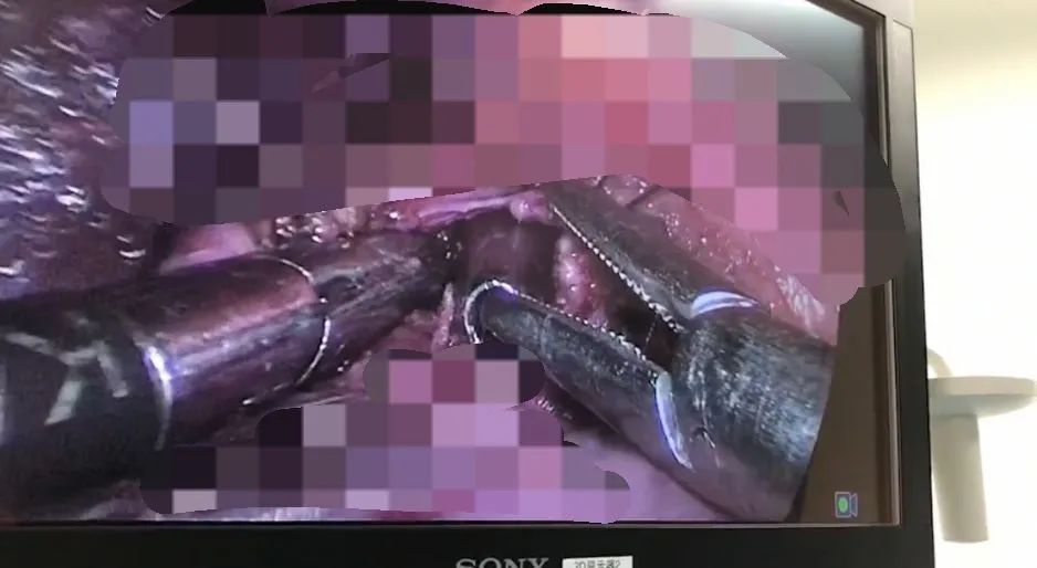 气道异物患者麻醉,小儿气道异物麻醉