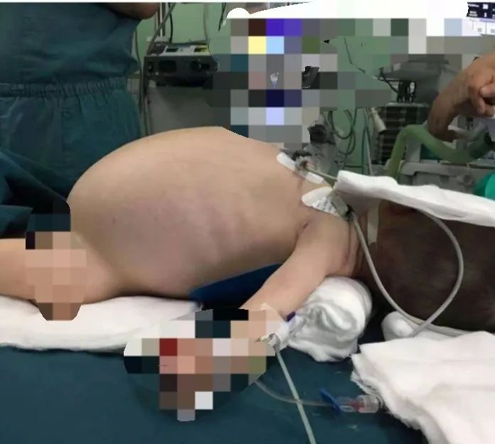 气道异物患者麻醉,小儿气道异物麻醉