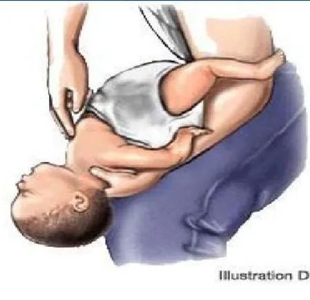 气道异物患者麻醉,小儿气道异物麻醉