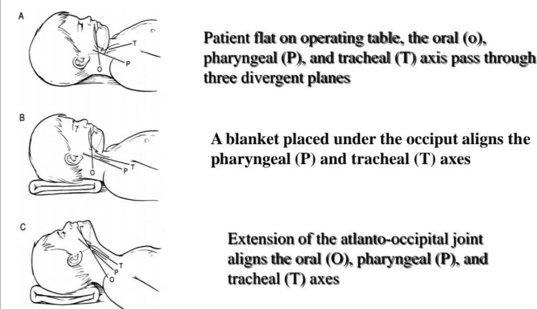 气道异物患者麻醉,小儿气道异物麻醉