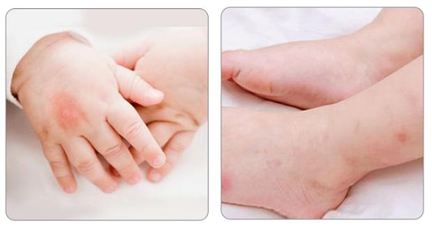 新升级↑像口红一样的紫草膏,远离痒痛,舒“肤”一夏