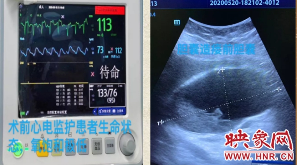 息县人民医院超声科成功开展息县第一例超声引导下经皮经肝胆囊穿刺造瘘术
