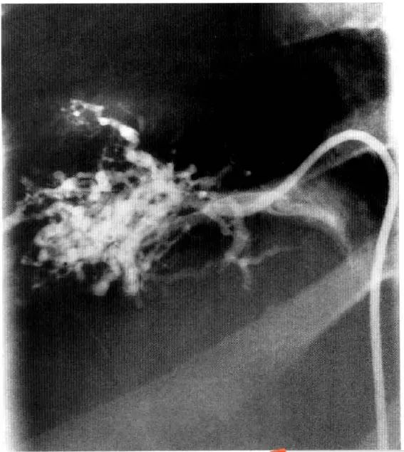 一文掌握：布加综合征的诊断要点