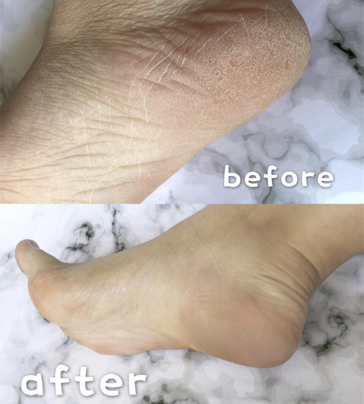 一招告别死皮老茧脚,去脚后跟老茧死皮的法子