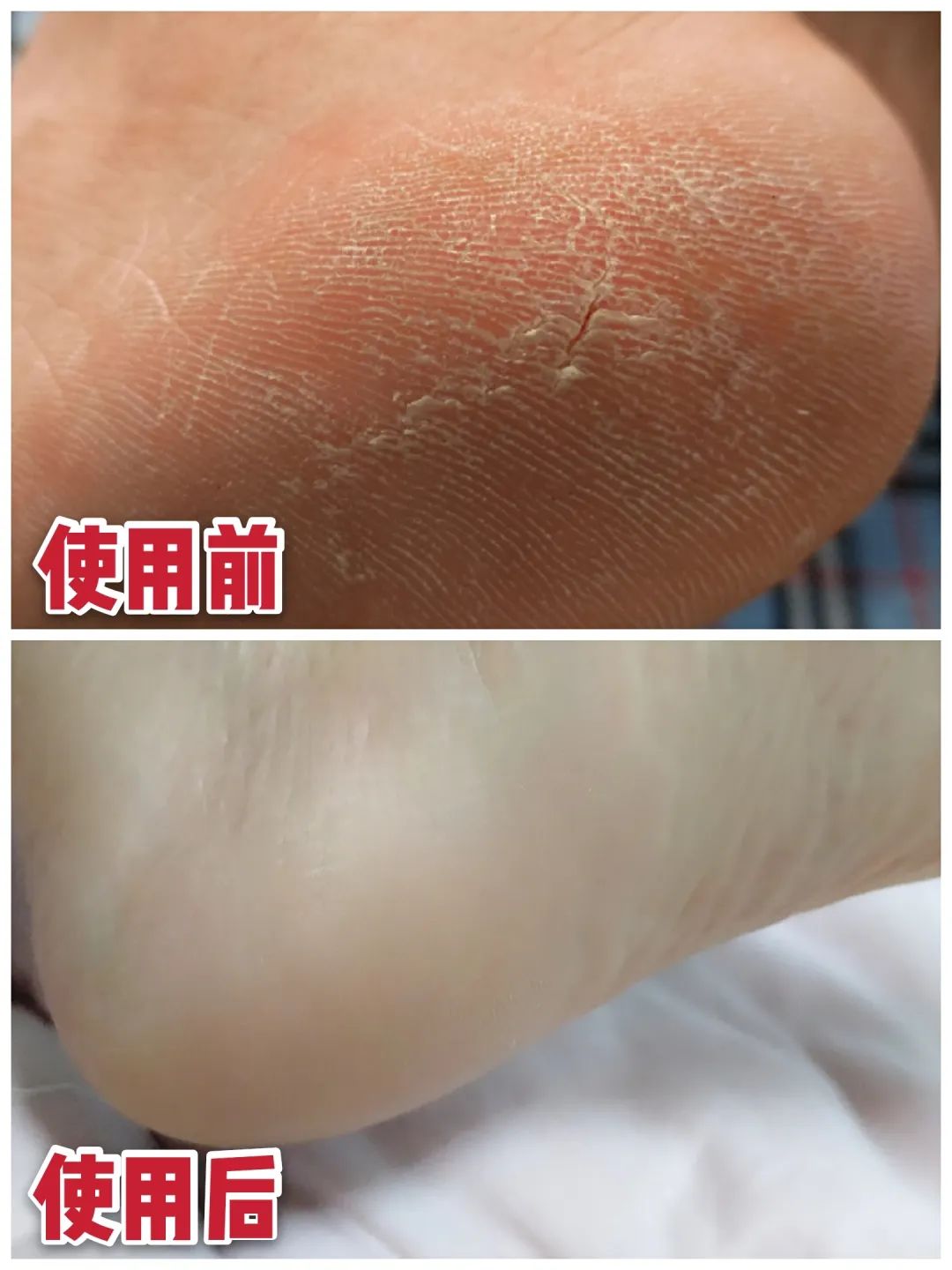 一招告别死皮老茧脚,去脚后跟老茧死皮的法子