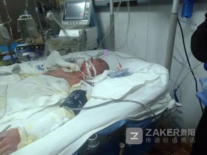 热水壶爆炸一家三口被特重度烧伤,热水器爆炸致一家三口重度烧伤