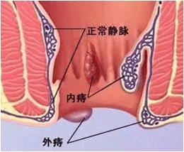 超声多普勒痔动脉结扎术利弊,超声刀治疗痔疮还需要内扎吗
