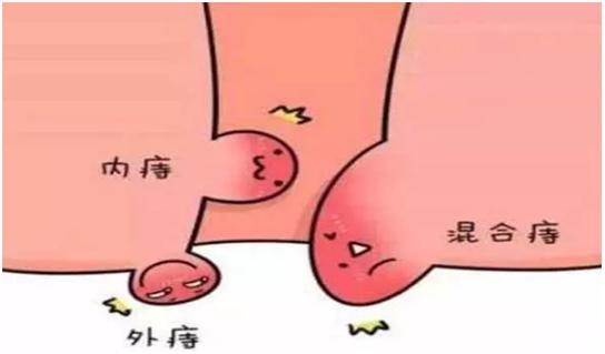 超声多普勒痔动脉结扎术利弊,超声刀治疗痔疮还需要内扎吗