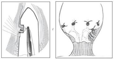 超声多普勒痔动脉结扎术利弊,超声刀治疗痔疮还需要内扎吗