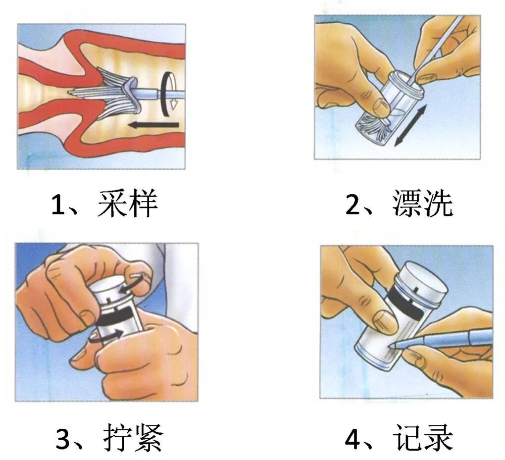 宫颈细胞学检查是怎么回事,宫颈细胞学检查di值超标