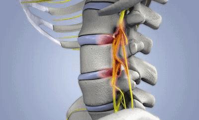 归国学子腰痛得无法入睡，中山七院骨科一招治好