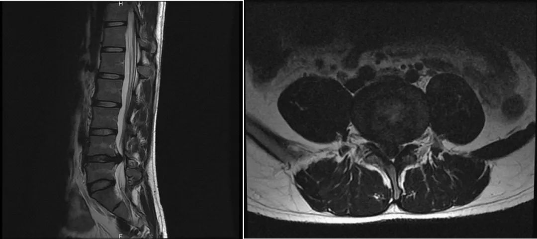 归国学子腰痛得无法入睡，中山七院骨科一招治好