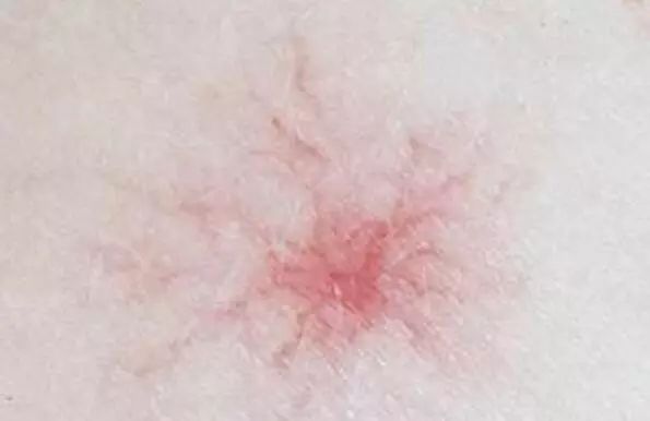 【注意】千万别大意!身上有这种小红痣,很可能是大病的预警信号…