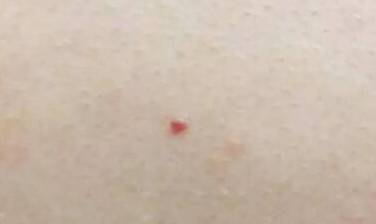 【注意】千万别大意!身上有这种小红痣,很可能是大病的预警信号…