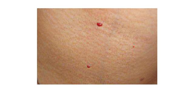 【注意】千万别大意!身上有这种小红痣,很可能是大病的预警信号…