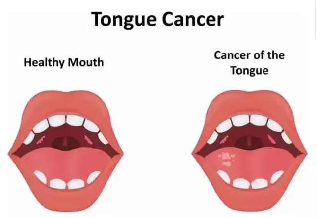 科普癌症筛查重要性,科普五个信号暗示癌症早期