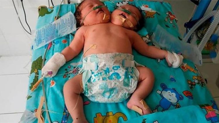 孕妇不听劝告生下连体婴儿,妻子怀孕查出是连体婴