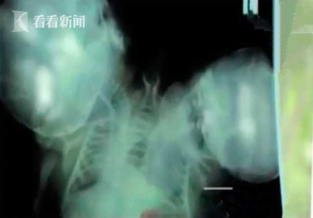 孕妇不听劝告生下连体婴儿,妻子怀孕查出是连体婴