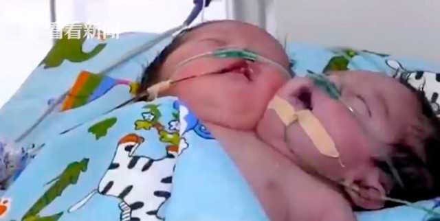 孕妇不听劝告生下连体婴儿,妻子怀孕查出是连体婴