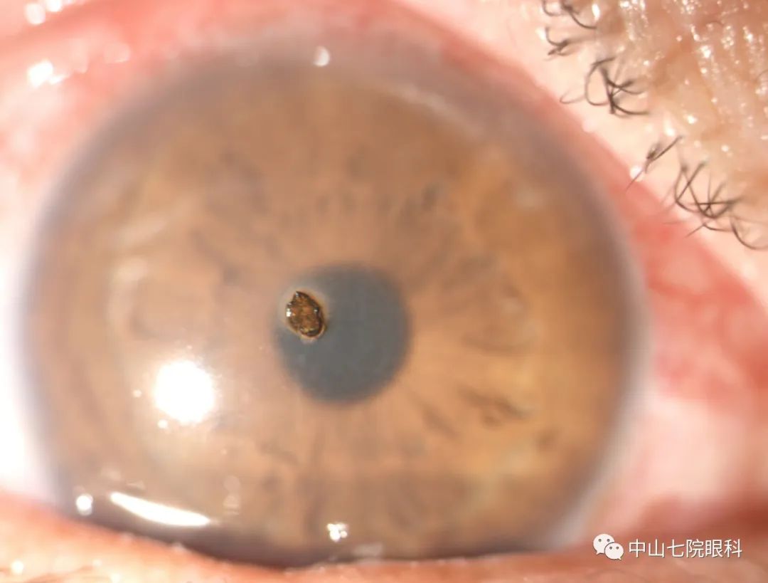 眼睛受外伤还能痊愈吗,眼睛受外伤的紧急处理办法