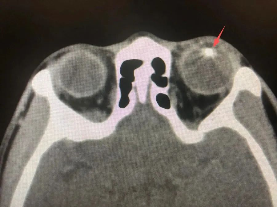 眼睛受外伤还能痊愈吗,眼睛受外伤的紧急处理办法
