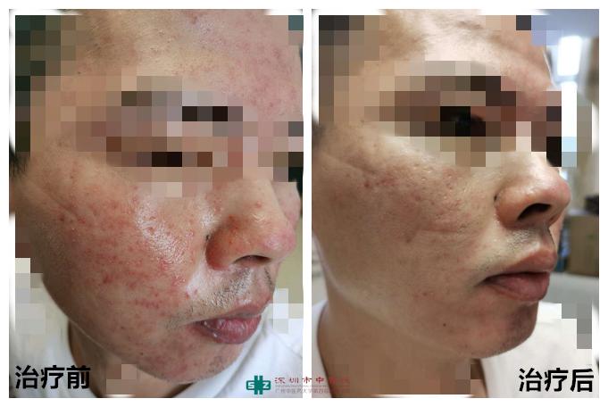 玉颜阁专业解决问题皮肤,玉颜阁祛痘