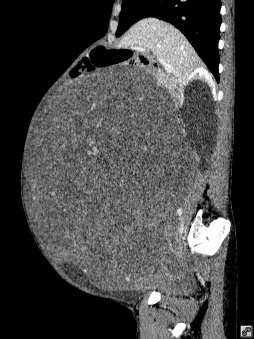 28岁女子取出80多个子宫肌瘤,55岁阿姨巨型肌瘤