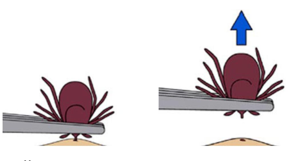 虫子爬到身体里,虫子爬到后背皮肤里面去了