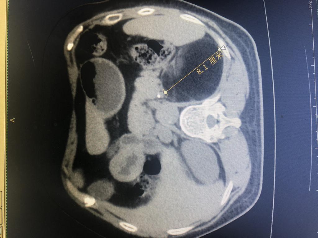 崇州人民医院微创手术,泌尿外科四川省人民医院