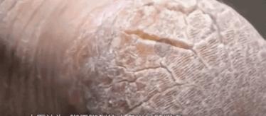 一招告别死皮老茧脚,去脚后跟老茧死皮的法子