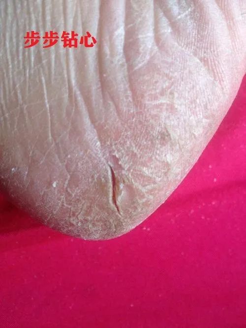 一招告别死皮老茧脚,去脚后跟老茧死皮的法子