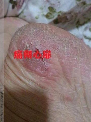 一招告别死皮老茧脚,去脚后跟老茧死皮的法子