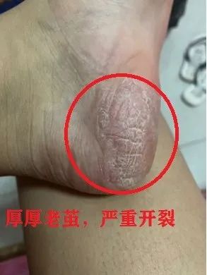 一招告别死皮老茧脚,去脚后跟老茧死皮的法子