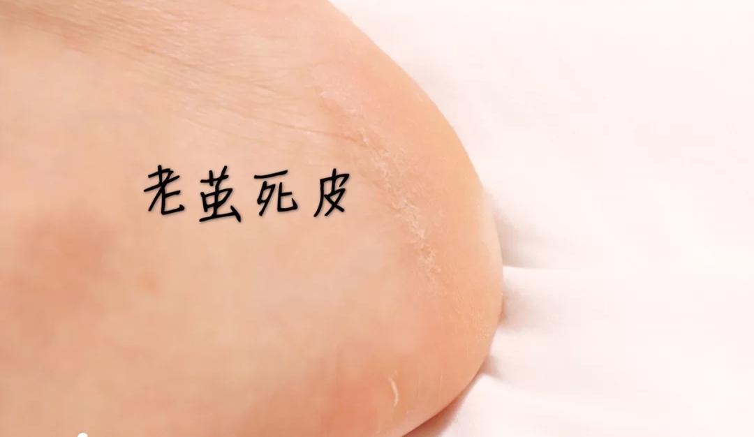 一招告别死皮老茧脚,去脚后跟老茧死皮的法子