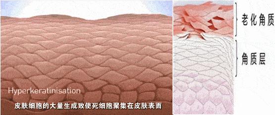 一招告别死皮老茧脚,去脚后跟老茧死皮的法子