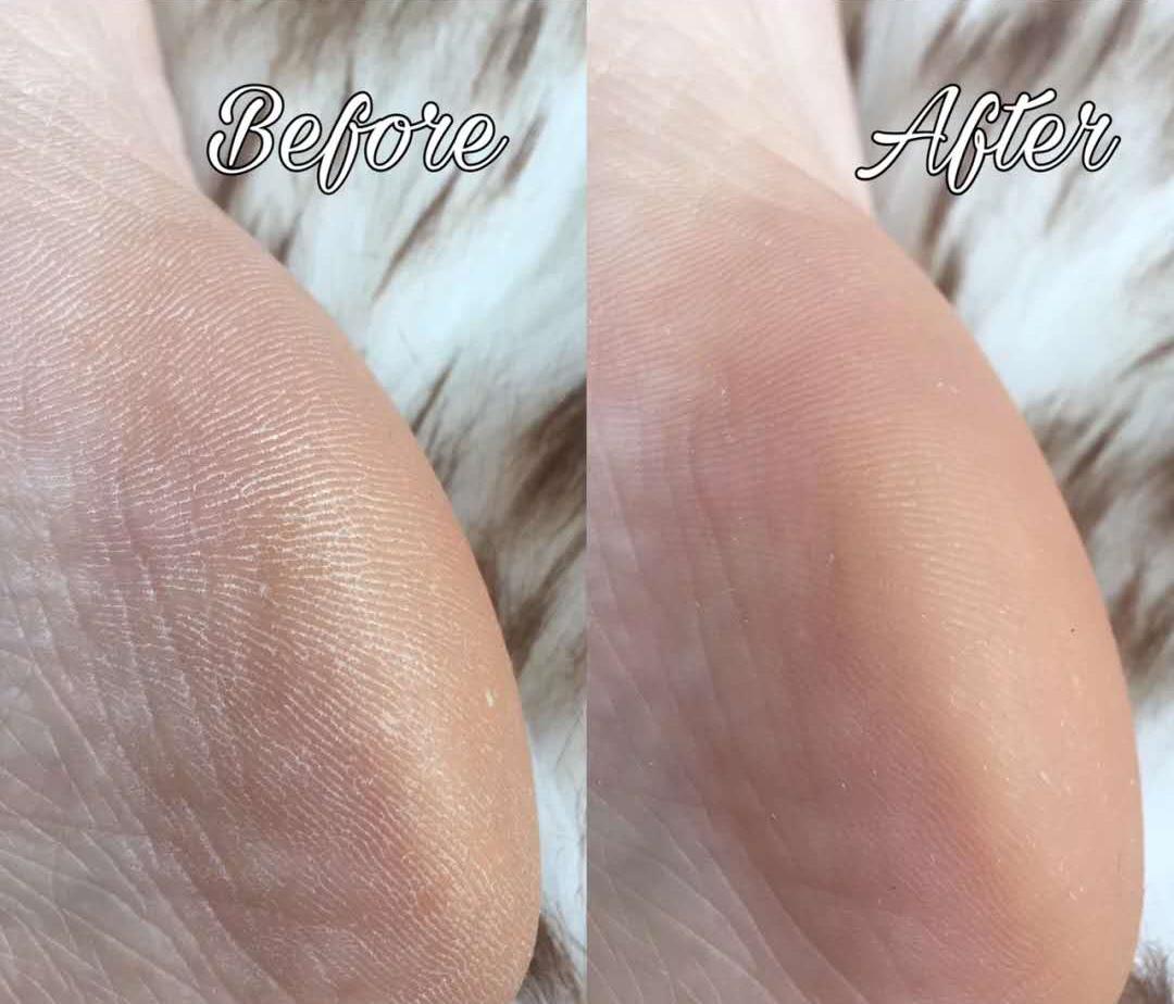 一招告别死皮老茧脚,去脚后跟老茧死皮的法子