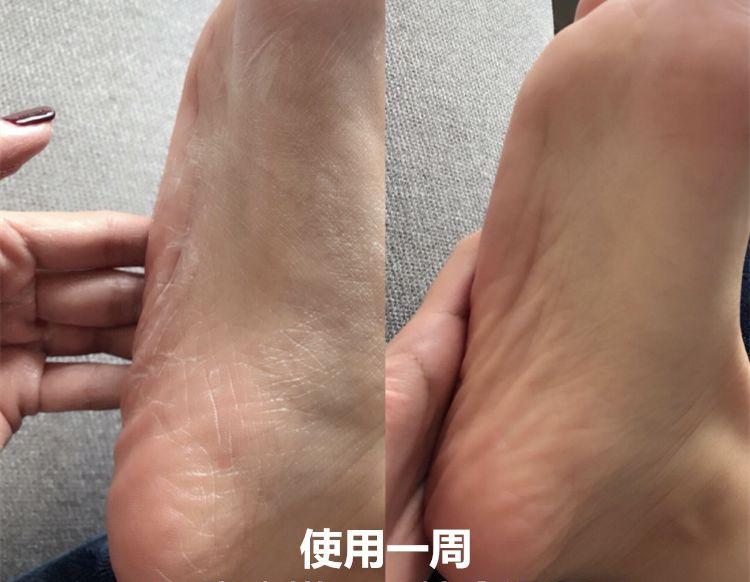 一招告别死皮老茧脚,去脚后跟老茧死皮的法子