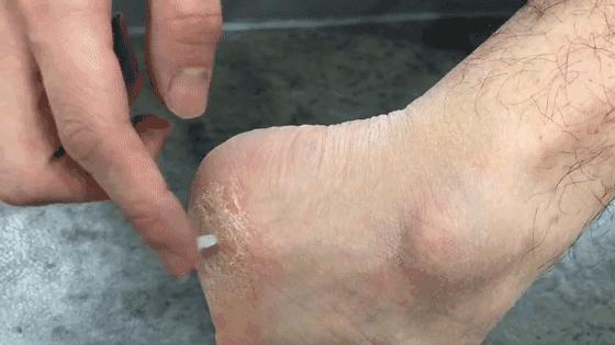一招告别死皮老茧脚,去脚后跟老茧死皮的法子