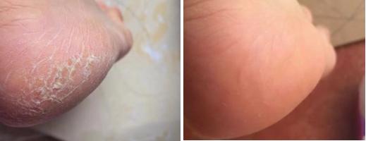 一招告别死皮老茧脚,去脚后跟老茧死皮的法子