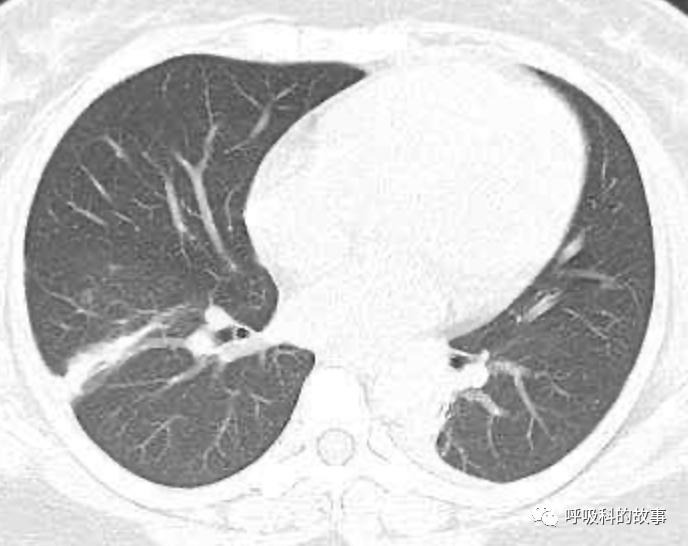 五花八门的发热之一—药物热（1）