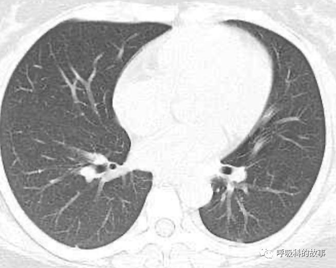 五花八门的发热之一—药物热（1）