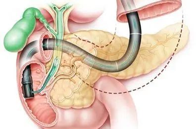 这种病不能忽视！上海交通大学附属第一人民医院（松江南院）专家和你聊聊胆石病