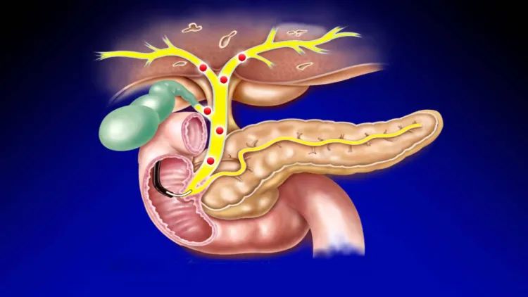 这种病不能忽视！上海交通大学附属第一人民医院（松江南院）专家和你聊聊胆石病